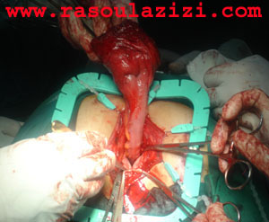 تصوير عمل جراحي براي درمان بيرون زدگي رکتوم از مقعد - پرولاپس مقعد